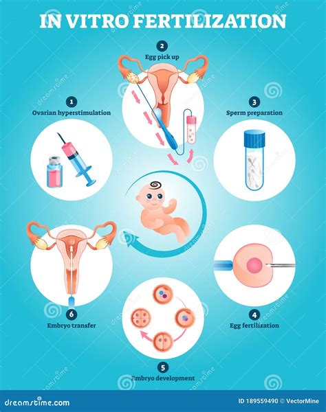 Stages Of In Vitro Fertilization Medical Banner Vector Illustration | CartoonDealer.com #145358656