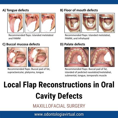 MAXILLOFACIAL SURGERY: Local Flap Reconstructions in Oral Cavity Defects - An Insight from 104 Cases