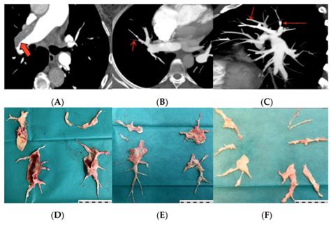 JCM | Special Issue : Pulmonary Hypertension: Current Diagnosis ...