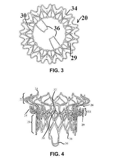 Device and Method for Mitral Valve Regurgitation Treatment - Eureka ...