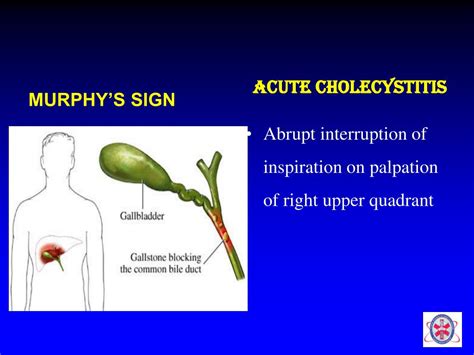 Image result for Psoas Sign