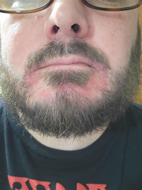 Rash on chin and nose : r/SkincareAddicts