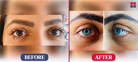 Image result for Eye Color Surgery