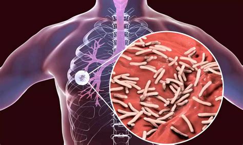 HACOR Score may predict NIV Failure among Post-TB Obstructive Airway ...