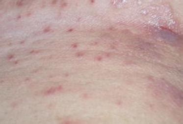 皮膚瘙癢症狀是怎麼引起的 - 每日頭條