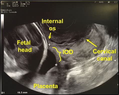 Low Lying Placenta