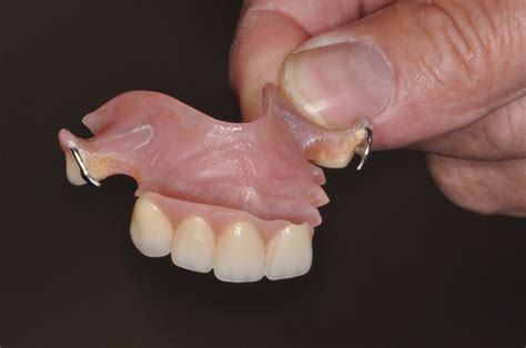 Image result for Front Teeth Partials Options