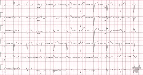 Paced Rhythms | ECG Stampede