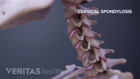 Cervical Spondylosis with Myelopathy