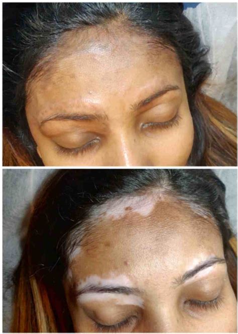 Tattoos By The Bay | Tattoo Studio in Walnut Creek, CA | Vitiligo ...