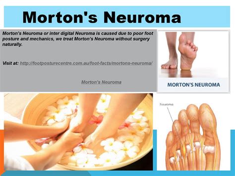 Morton's Neuroma Treatment Exercises - Quotes Trendy