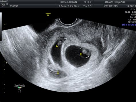 生殖专家徐键院长「主刀」，义乌第一例多胎妊娠减胎术成功实施！ － 丁香园