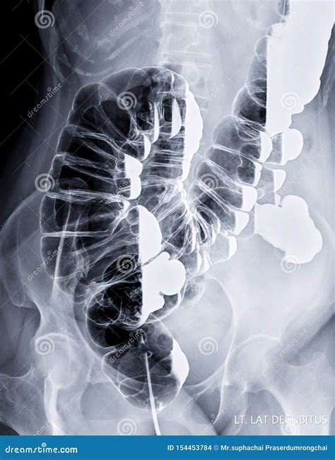 Left Lateral Decubitus Position