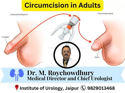 Circumcision in Adults: Medical Benefits, Indications, and Myths