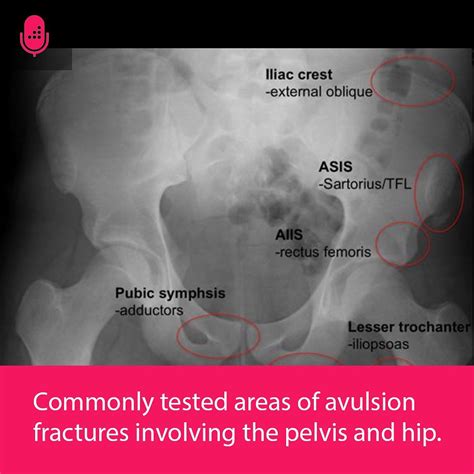 Avulsion Fracture Hip Iliac Crest