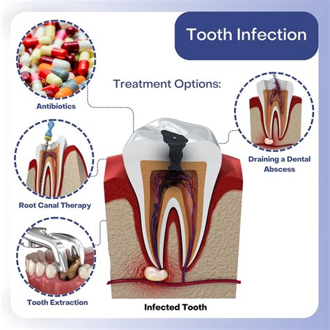 Infected Tooth Extraction Procedure 的图像结果