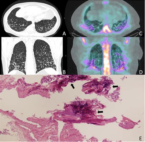 Pulmonary Calcifications: A Reflection of Renal Impairment | Open ...