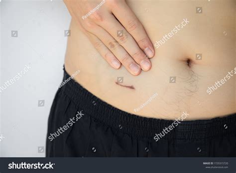 Image result for Appendix Surgery Scar
