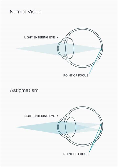 Stigmatism Vs. Astigmatism , Astigmatism vs. Myopia: What’s the ...