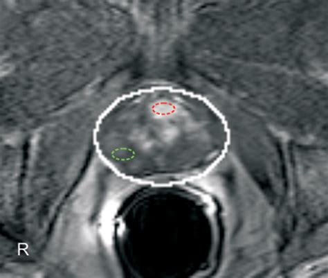 Dynamic Contrast-Enhanced MRI of Prostate Cancer at 3 T: A Study of ...