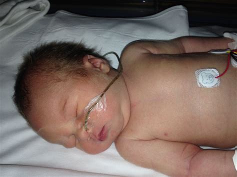 How To Insert Ng Tube In Baby at Carolyn Redington blog