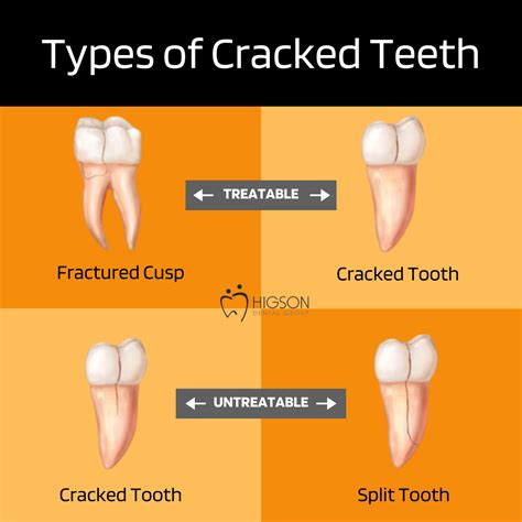 Cracked Tooth Repair - Common Causes and Fixes For Cracked Teeth | Emergency Dentist Offering ...