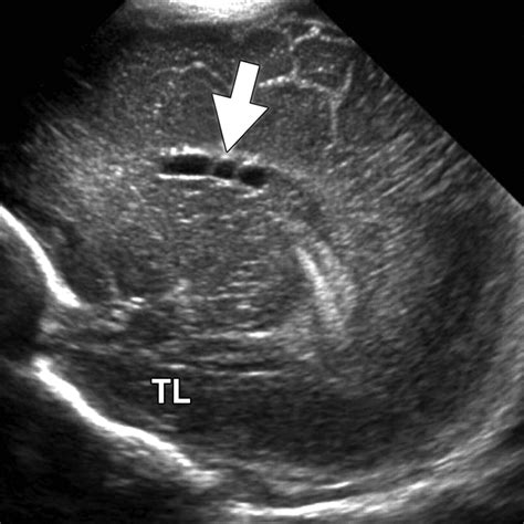 State-of-the-Art Cranial Sonography: Part 2, Pitfalls and Variants | AJR