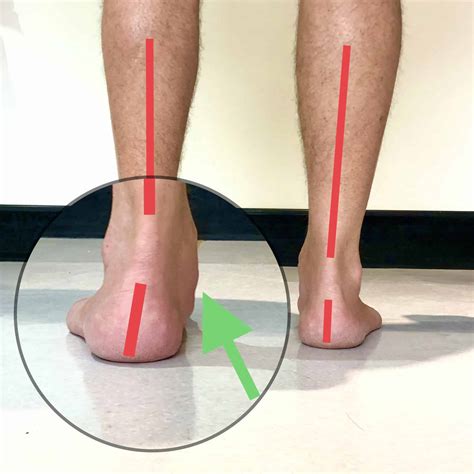 Fallen Arches or Flat Feet and what you need to know - A Step Ahead Foot and Ankle Care