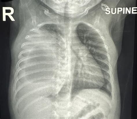 “Equal breath sounds bilaterally” : r/Radiology