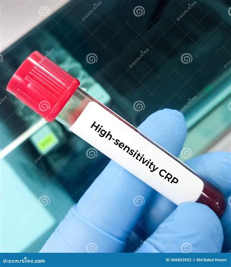 Blood Sample for Hs-CRP (high Sensitivity - CRP) Test, for the Diagnosis of Inflammatory Heart ...