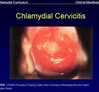 cervicitis 的图像结果