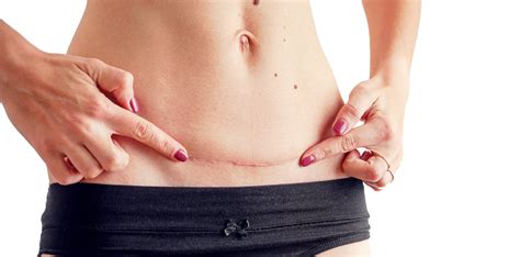 C-Section Scar Healing Stages: Tips and Treatments for Optimal Recovery
