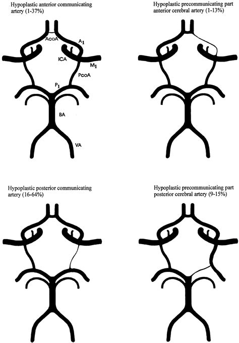 Missing Posterior Communicating Artery