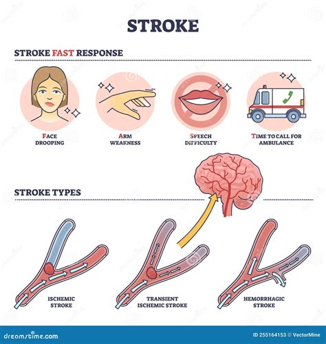 Stroke Medical Condition with Fast Response and Attack Types Outline Diagram Stock Vector ...