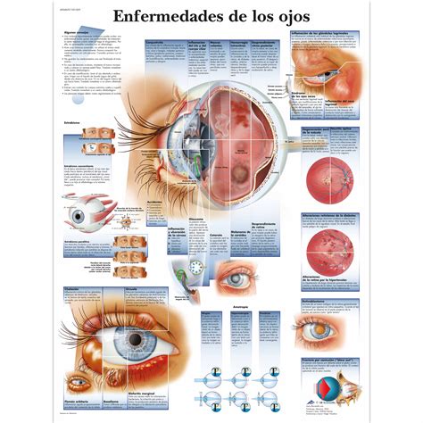 Enfermedades de los ojos | 4006829 | 3B Scientific | VR3231UU ...