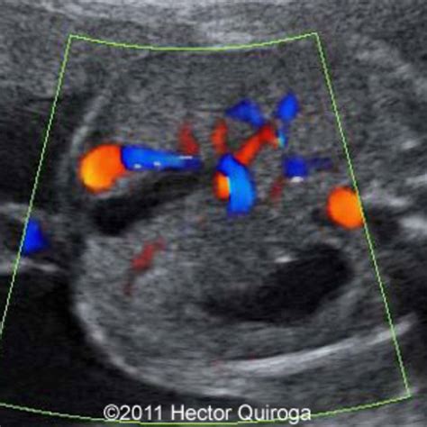 📃 Persistent right umbilical vein