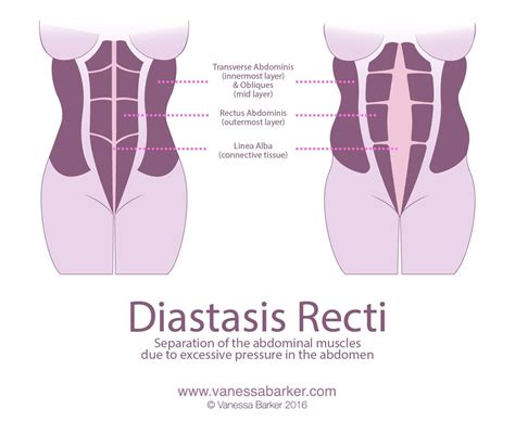 Core Exercise Diastasis Recti at Hamish Payne blog