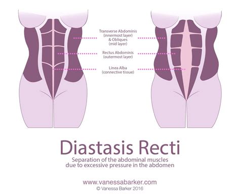 Do You Have Diastasis Recti? - Vanessa Barker Fitness
