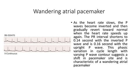 COMPLETE ATRIOVENTRICULAR HEART BLOCK.pptx