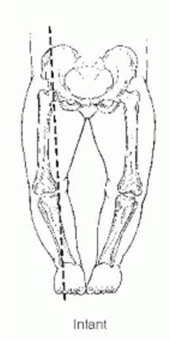 Image result for Normal Leg Alignment