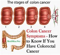 colon cancer 的图像结果