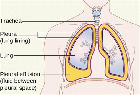 Bilateral Pleural Effusion: Symptoms, Causes And Treatment | OnlyMyHealth
