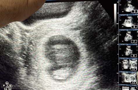 9 week ultrasound shows no limbs, please advise :( : r/obgyn
