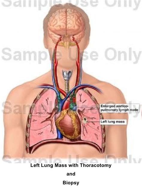 Image result for Open Chest Thoracotomy
