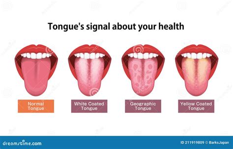 White Or Coated Tongue. Dry Mouth. Open Human Taste Organ With Symptoms Of Stomatitis ...