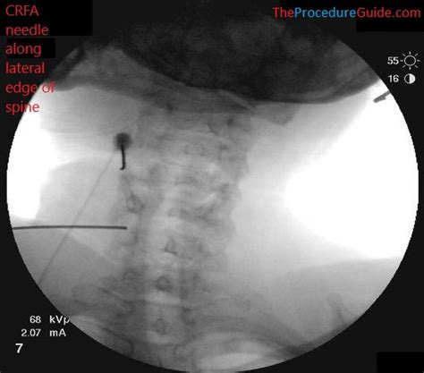 Fluoroscopy Injection 的图像结果
