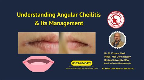 Angular Cheilitis - Boston Aesthetics