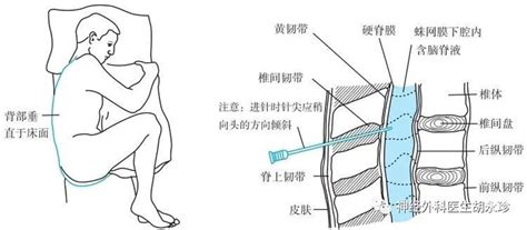 七、腰椎穿刺术-急救医学-医学