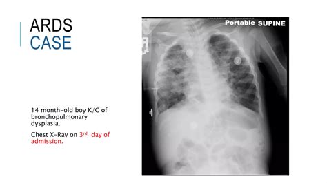 pediatric Acute Respiratory Distress Syndrome ( ARDS ) | PPTX