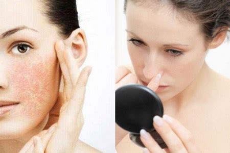 脸部脱皮怎么解决，几种方法改善脸部脱皮问题